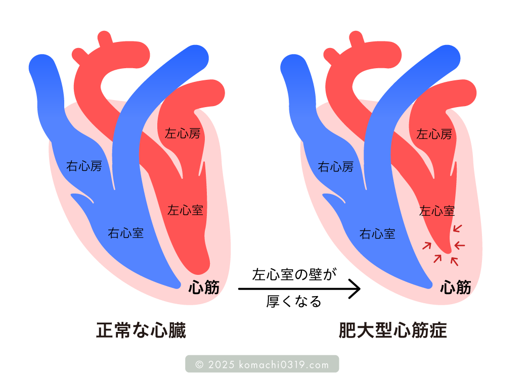肥大型心筋症
