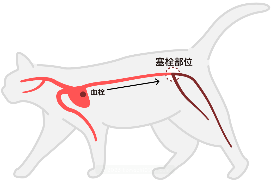 肥大型心筋症